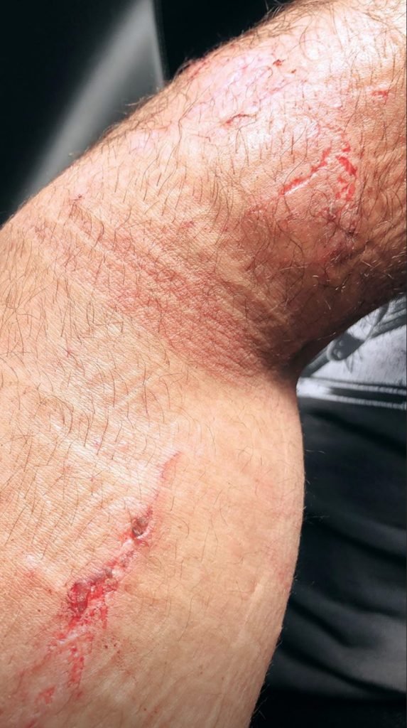 Seth Rollins injury update and photos