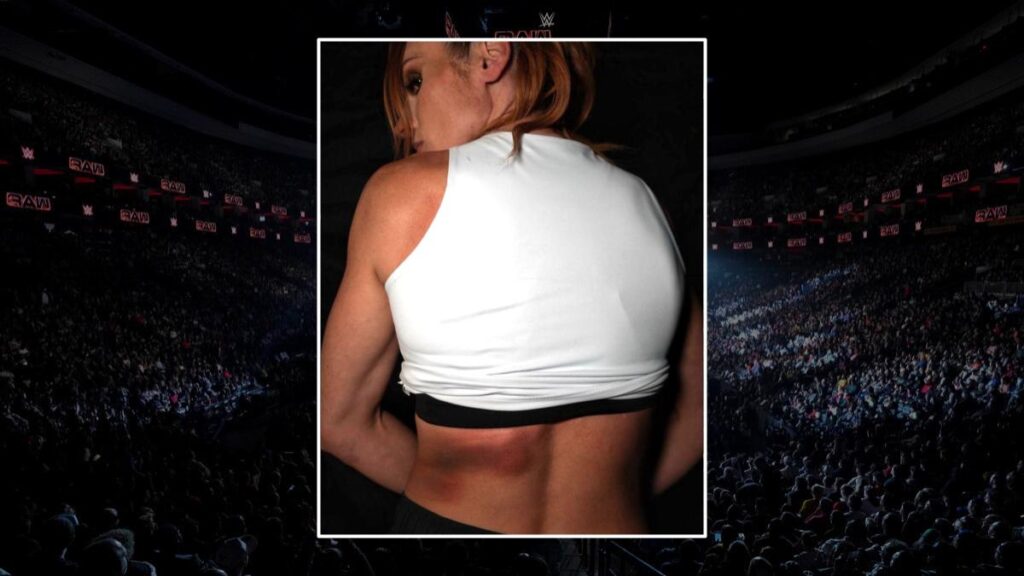 Becky Lynch back bruise after WWE Raw on July 28